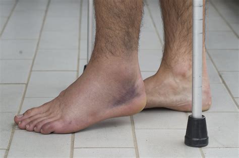 Rolled Ankle Symptoms