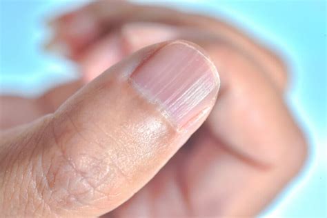 Linhas Brancas Na Unha - Por que aparecem linhas nas unhas e como eliminá-las?