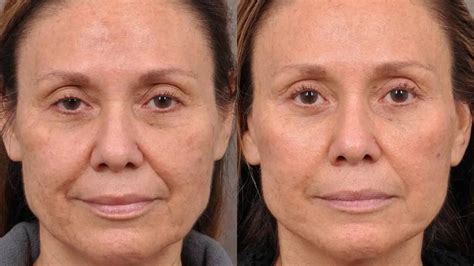 Sculptra Antes E Depois - Sculptra: o que é, antes e depois e quando realizar