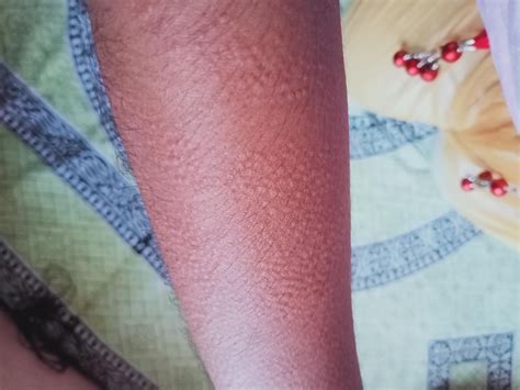 Does it look like Cholinergic Urticaria?? : r/CholinergicUrticaria