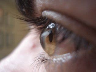Cornea Specialist In Pune - Axis Eye Clinic