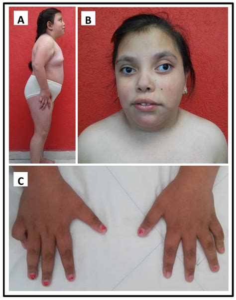 Turner Syndrome 45 Xo at Karen Medina blog