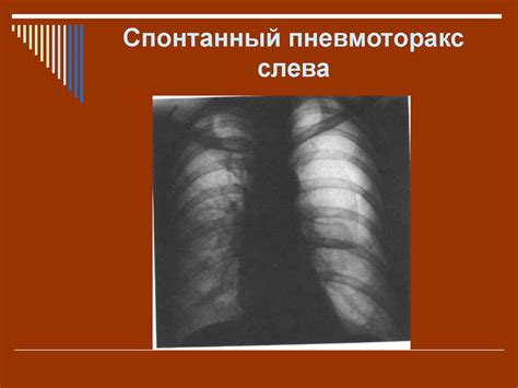 Спонтанный пневмоторакс - презентация онлайн