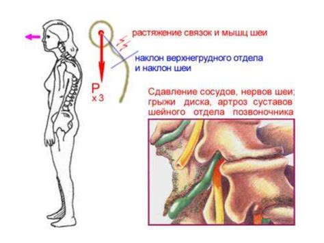 Лечебная физкультура при нарушениях осанки - презентация онлайн