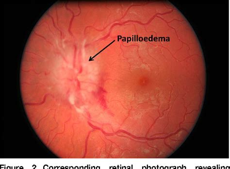 Papilledema Signs