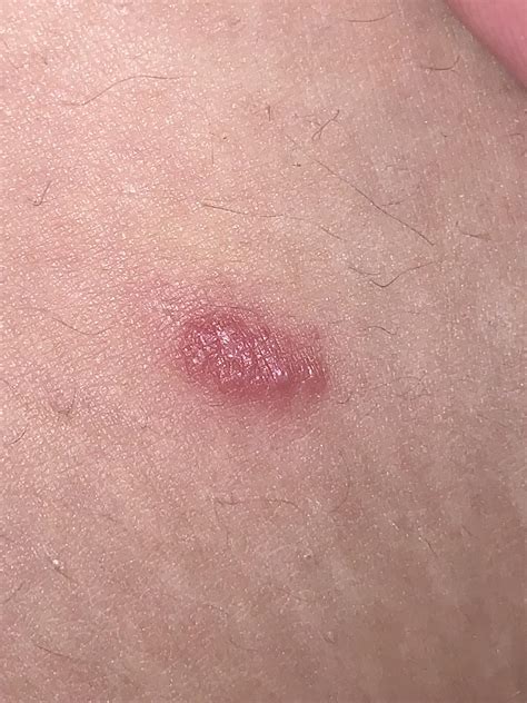 Found this on my inner thigh, It doesn’t itch and it appeared about a