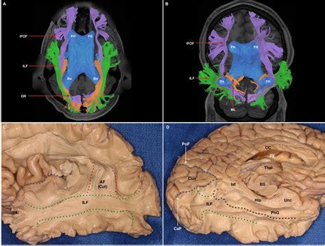 inferior longitudinal fasciculus