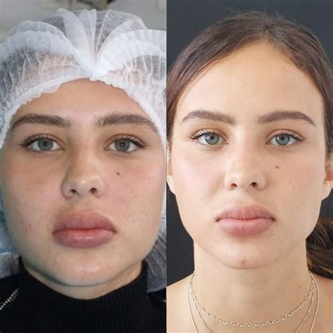 Bichectomia Antes E Depois - Bichectomia: Antes e depois – Antes da Fama