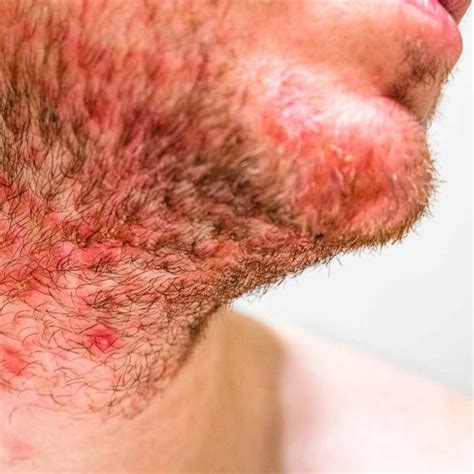 Skincare SOS: How to Tell if Acne is Hormonal or Bacterial!
