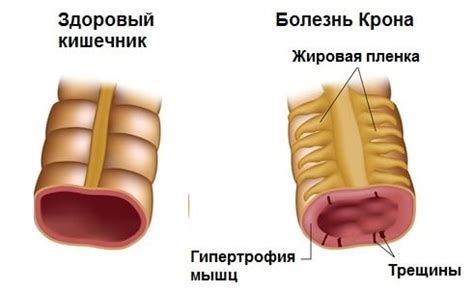 Болезнь Крона: симптомы, фото, лечение у взрослых