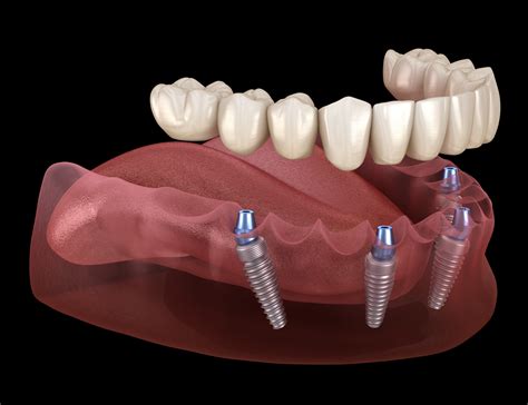 Dental Implants Are Truly Life-Changing - Restorative Dentistry