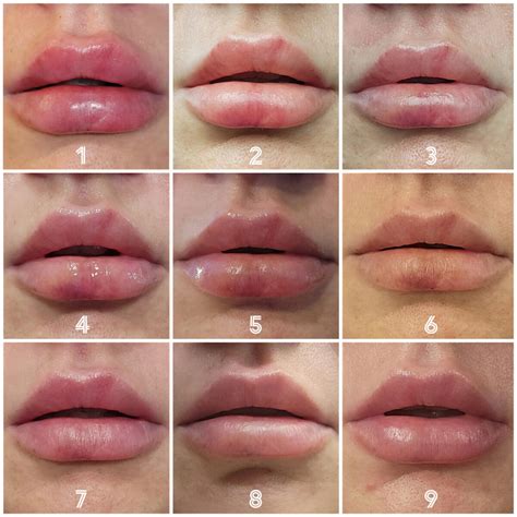 pictures bruising  lip fillers swelling infoupdateorg