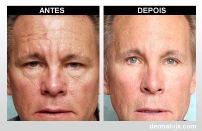 Microagulhamento Antes E Depois Rugas