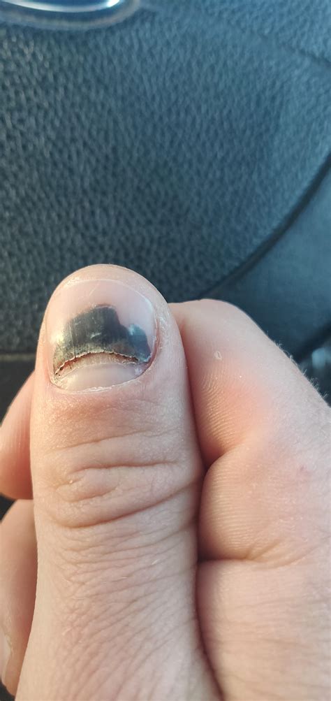 Subungual hematoma - so I keep being told : r/mildlyinteresting