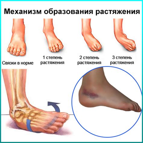 Растяжение лодыжки и щиколтки: симптомы и лечение травмы связок