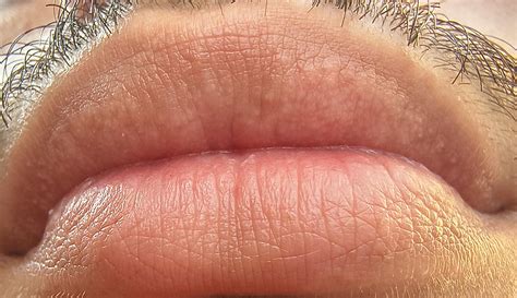 White Spots On Lips Actinic Keratosis: Signs And Symptoms