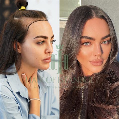 Hair transplant women – Artofit