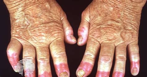 Acrodermatitis continua of Hallopeau image