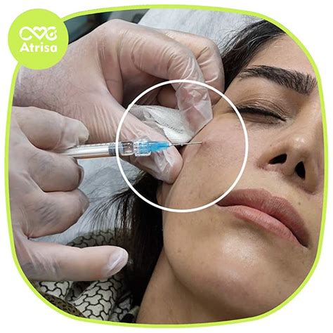 تزریق فیلر زیر چشم چگونه انجام می شود؟ | کلینیک تخصصی پوست و مو آتریسا