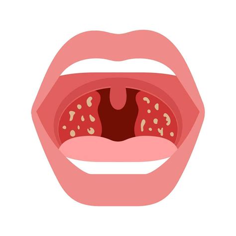 pain  throat tonsillitis  human open mouth  infection plugs