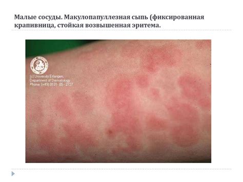 Систематизация и диагностика васкулитов - online presentation