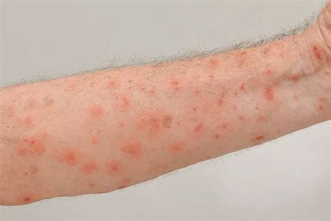 Alergia A Acaro Na Pele - Como acabar com ácaros na pele? - DR Clean