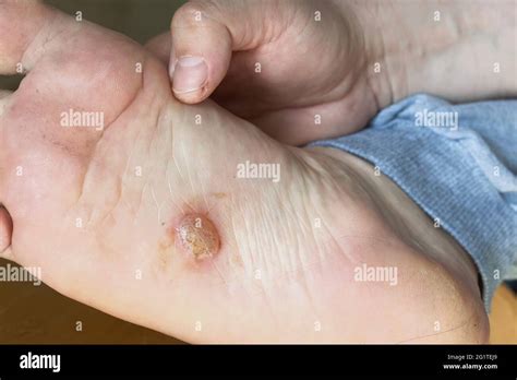 El eccema dishidrotico fotografías e imágenes de alta resolución - Alamy