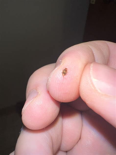 Carpet beetle? : r/Bedbugs