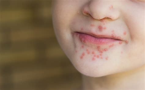 Virus Coxsackie, qué es y cómo prevenirlo