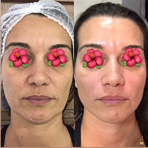 Botox Bigode Chines Antes E Depois - Bigode chinês: o que é, tratamentos e exercícios [ANTES E DEPOIS]