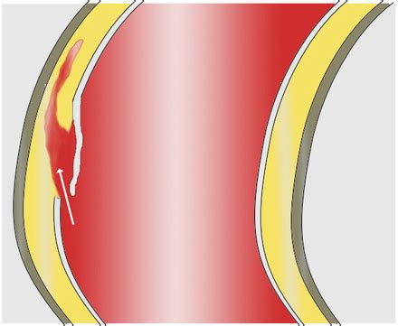 Dissezione aortica - frwiki.wiki
