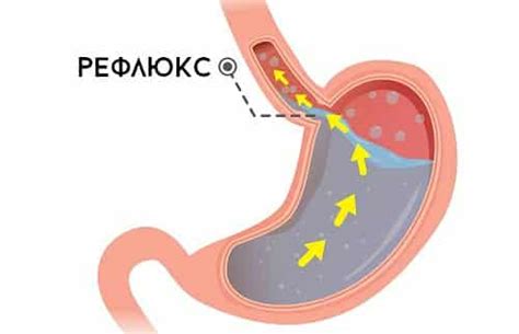 Рефлюкс-гастрит: виды, симптомы, диета и лечение