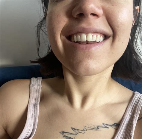 Chipped dead tooth - looking for cosmetic procedure advice : r/askdentists