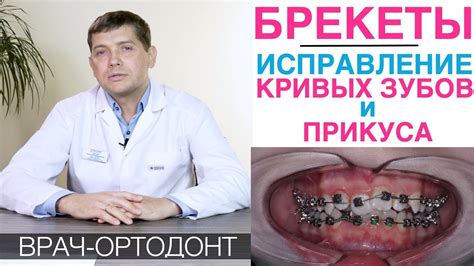 Брекеты - исправление кривых зубов и неправильного прикуса брекетами ...