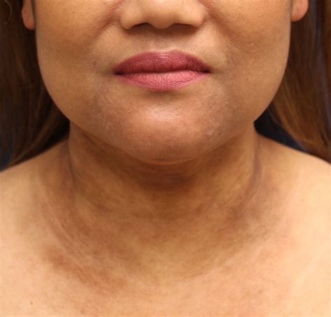 Erythema Dyschromicum Perstans – Digital Dermatology Atlas