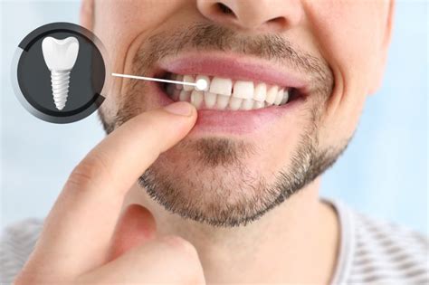 Factors in dental implant success