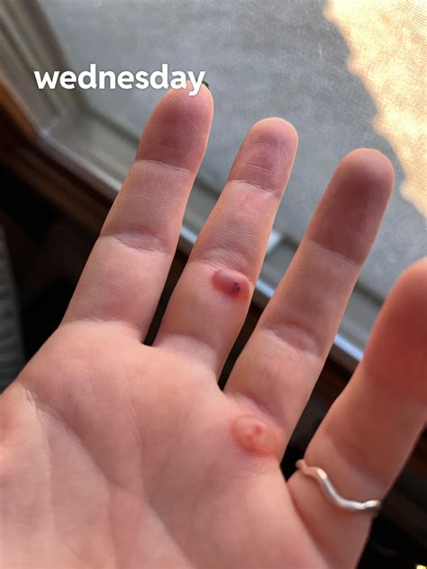 blood blister after freezing wart : r/Warts