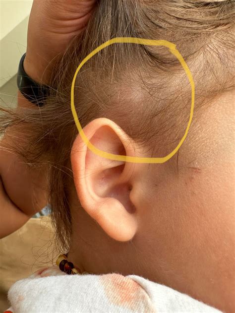 Toddler has lump above ear : r/medical_advice