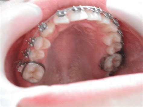 aspect  upper arch   months  scientific diagram