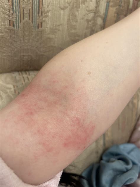 Persistent rash on breasts and inner arm, please help! : r/medical