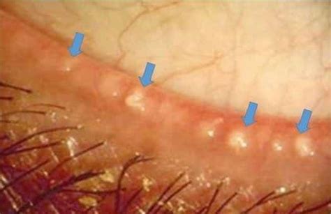 Demodex Ocular