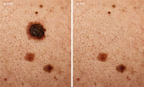skin moles types