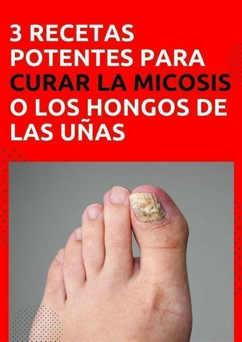 SOLUCIONES CASERAS PARA CURAR LOS HONGOS EN LAS UÑAS | Tratamiento para ...