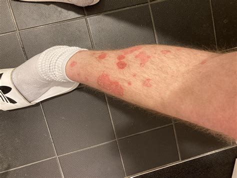 Scaly red spots on legs, stomach and arms : r/DermatologyQuestions