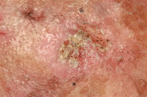 Signs Of Skin Cancer Scaly Patches at Helen Mckenzie blog