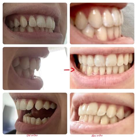 Deep bite before and after. 24 months in total. Switched orthodontists ...