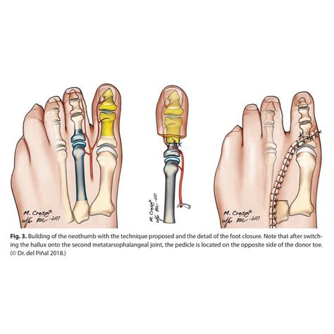 thumb reconstruction strategies primary anatomy