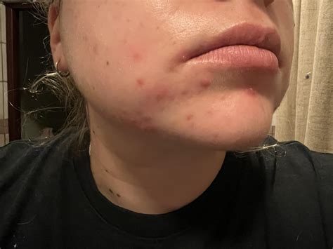 Cystic acne on chin from hormonal imbalances - changed from Mirena to