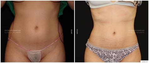 Lipo Na Barriga Antes E Depois