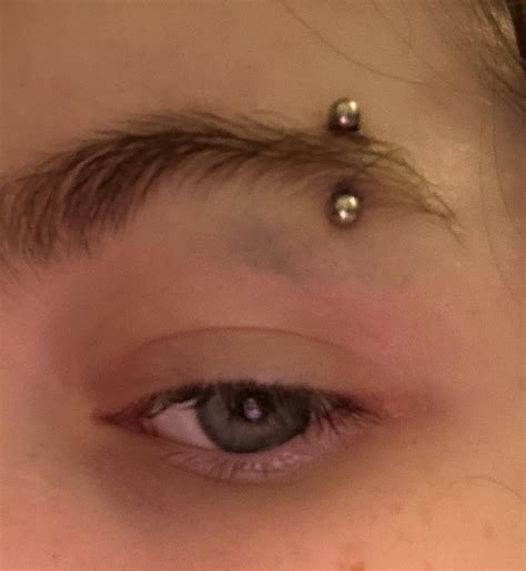 piercing is bruised, is this normal for the healing process? i got it